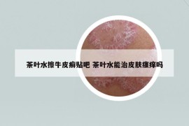 茶叶水擦牛皮癣贴吧 茶叶水能治皮肤瘙痒吗