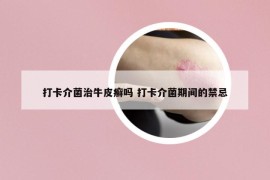 打卡介菌治牛皮癣吗 打卡介菌期间的禁忌