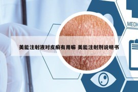 美能注射液对皮癣有用嘛 美能注射剂说明书
