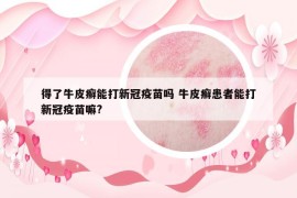 得了牛皮癣能打新冠疫苗吗 牛皮癣患者能打新冠疫苗嘛?