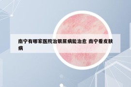 南宁有哪家医院治银屑病能治愈 南宁看皮肤病