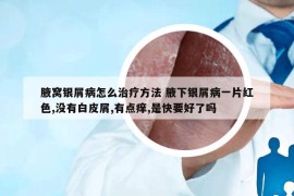 腋窝银屑病怎么治疗方法 腋下银屑病一片红色,没有白皮屑,有点痒,是快要好了吗