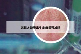 怎样才能看出牛皮癣是否减轻