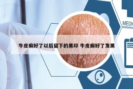 牛皮癣好了以后留下的黑印 牛皮癣好了发黑