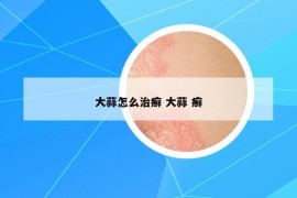 大蒜怎么治癣 大蒜 癣