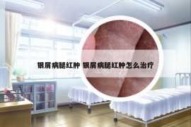 银屑病腿红肿 银屑病腿红肿怎么治疗