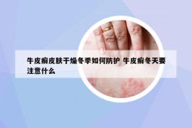 牛皮癣皮肤干燥冬季如何防护 牛皮癣冬天要注意什么