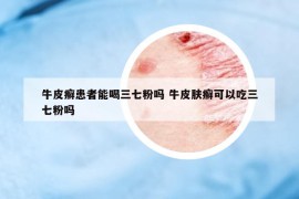 牛皮癣患者能喝三七粉吗 牛皮肤癣可以吃三七粉吗