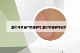 重庆可以治疗银屑病吗 重庆银屑病排名第一