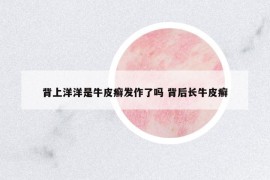 背上洋洋是牛皮癣发作了吗 背后长牛皮癣