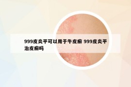 999皮炎平可以用于牛皮癣 999皮炎平治皮癣吗
