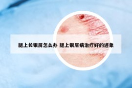 腿上长银屑怎么办 腿上银屑病治疗好的迹象