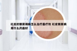 红皮的银屑病癣怎么治疗最疗效 红皮银屑病用什么药最好