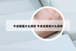 牛皮癣是什么症状 牛皮皮癣有什么症状