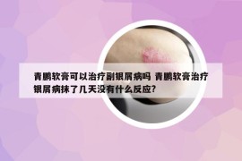 青鹏软膏可以治疗副银屑病吗 青鹏软膏治疗银屑病抹了几天没有什么反应?