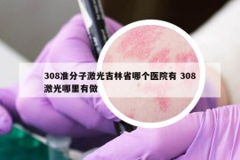 308准分子激光吉林省哪个医院有 308激光哪里有做