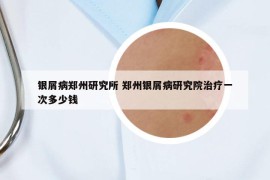 银屑病郑州研究所 郑州银屑病研究院治疗一次多少钱
