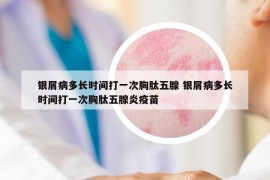 银屑病多长时间打一次胸肽五腺 银屑病多长时间打一次胸肽五腺炎疫苗