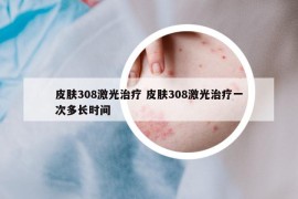 皮肤308激光治疗 皮肤308激光治疗一次多长时间