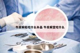 牛皮癣能吃什么补品 牛皮癣宜吃什么