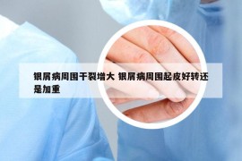 银屑病周围干裂增大 银屑病周围起皮好转还是加重