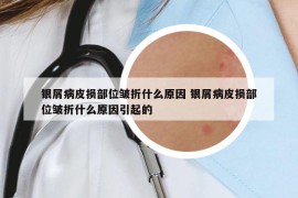 银屑病皮损部位皱折什么原因 银屑病皮损部位皱折什么原因引起的
