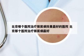 北京哪个医院治疗银屑病效果最好的医院 北京那个医院治疗银屑病最好