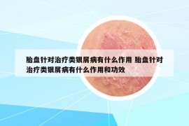 胎盘针对治疗类银屑病有什么作用 胎盘针对治疗类银屑病有什么作用和功效