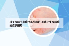 孩子皮肤牛皮癣什么引起的 小孩子牛皮肤癣的症状图片