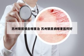 苏州银屑病去哪里治 苏州银屑病哪里医院好