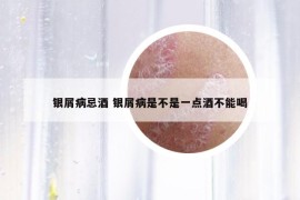 银屑病忌酒 银屑病是不是一点酒不能喝
