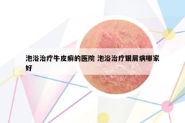 泡浴治疗牛皮癣的医院 泡浴治疗银屑病哪家好