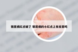 银屑病红点破了 银屑病的小红点上有皮屑吗
