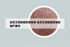 急性泛发脓疱型银屑病 急性泛发脓疱型银屑病严重吗
