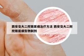 西安交大二院银屑病治疗方法 西安交大二附院银屑病生物制剂