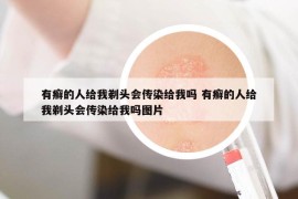 有癣的人给我剃头会传染给我吗 有癣的人给我剃头会传染给我吗图片