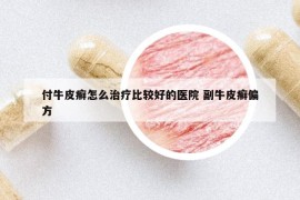 付牛皮癣怎么治疗比较好的医院 副牛皮癣偏方