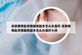 皮肤瘙痒起疙瘩越抓越多怎么办是好 皮肤瘙痒起疙瘩越抓越多怎么办是好小孩
