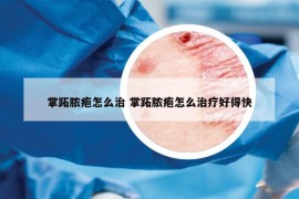 掌跖脓疱怎么治 掌跖脓疱怎么治疗好得快