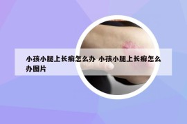 小孩小腿上长癣怎么办 小孩小腿上长癣怎么办图片