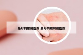 最好的银屑医院 最好的银屑病医院