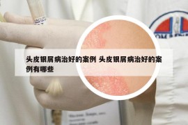 头皮银屑病治好的案例 头皮银屑病治好的案例有哪些