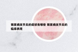 银屑病关节炎的症状有哪些 银屑病关节炎的临床表现
