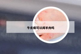 牛皮癣可以闻羊肉吗