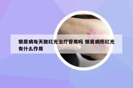 银屑病每天做红光治疗管用吗 银屑病照红光有什么作用