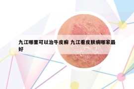 九江哪里可以治牛皮癣 九江看皮肤病哪家最好