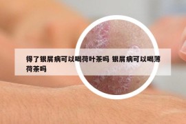 得了银屑病可以喝荷叶茶吗 银屑病可以喝薄荷茶吗