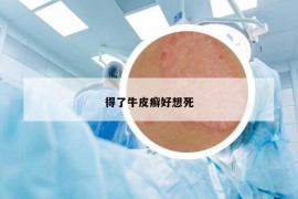 得了牛皮癣好想死