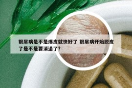 银屑病是不是爆皮就快好了 银屑病开始脱皮了是不是要消退了?