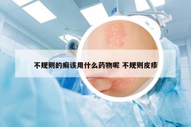 不规则的癣该用什么药物呢 不规则皮疹